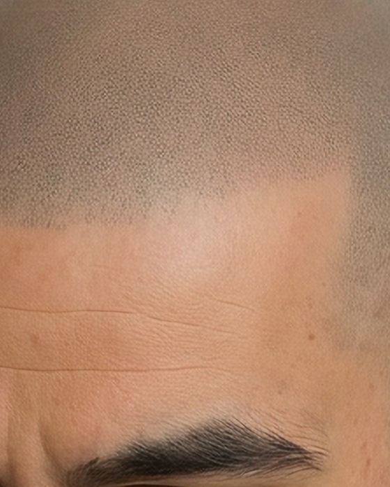 Restore your hairline